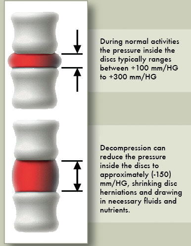 Spinal Disc Decompression Comparison Chart